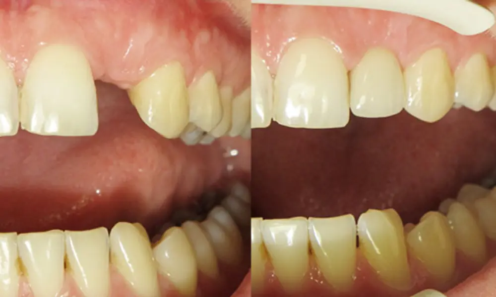 Zubní implantáty - galerie
